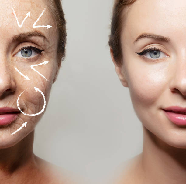 رفع چین و چروک های پنجه کلاغی با تزریق بوتاکس